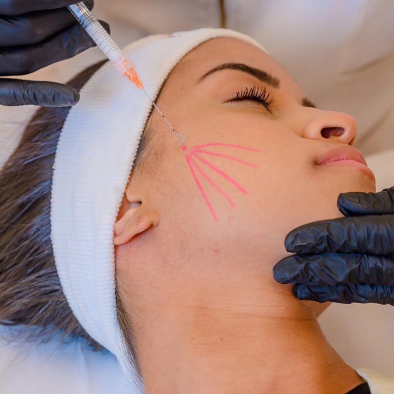 bioestimulador-de-colageno-radiesse-bio-renew-clinica-de-estetica